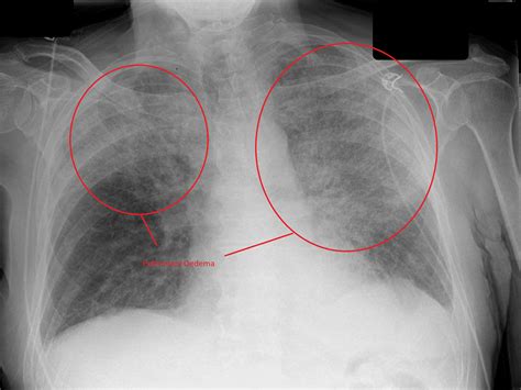 Pulmonary Edema Chest X Ray