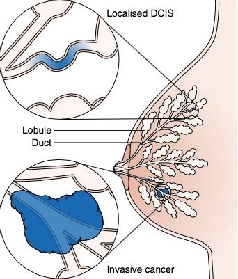 What You Should Know About Invasive Ductal Carcinoma