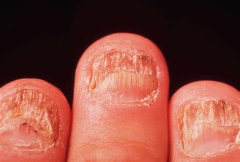 Pictures of Skin Infections