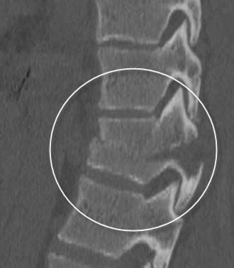 Chance Fracture of Spine | Bone and Spine