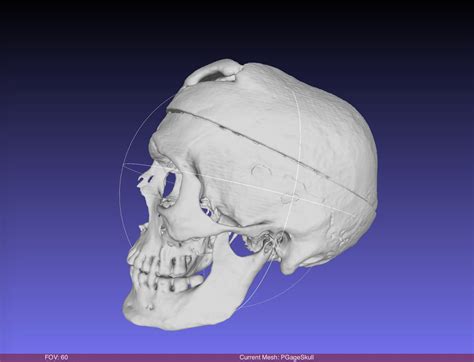 Phineas Gage Skull, harvard CT SCAN, Museum Quality High Resolution STL ...