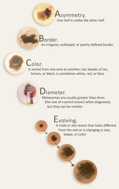 Moles That Change Color