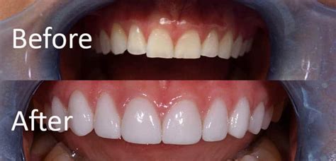 Veneers vs. dental crowns: Comparison and how to choose the best option ...