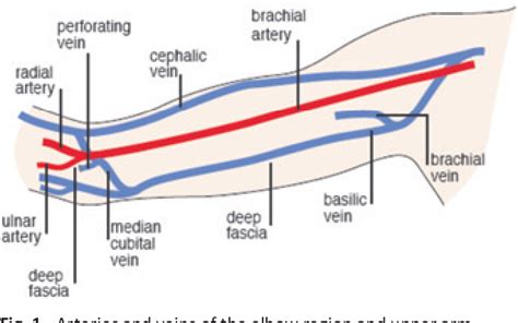 Figure 1 from Brachiocephalic and Basilic Fistula | Semantic Scholar