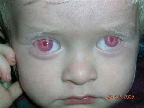 Red Eyes In Kids : Albino child with red eyes | Albino human, Albinism ...