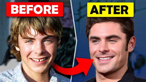 What happened to Zac Efron's teeth?...Orthodontist EXPLAINS - YouTube