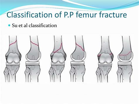 Periprosthetic Fracture Classification