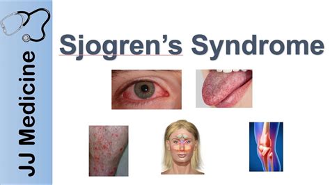 Sjogren’s Syndrome ("Dry Eye Syndrome") | Primary vs. Secondary ...