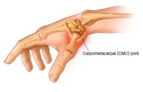 Base of Thumb Arthritis - GC Hand Therapy