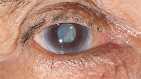 CATARACT EVALUATION AND SURGERY - PghEyeMeds