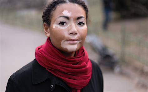 Vitiligo: Types, Symptoms, Diagnosis & Treatments – SkinKraft