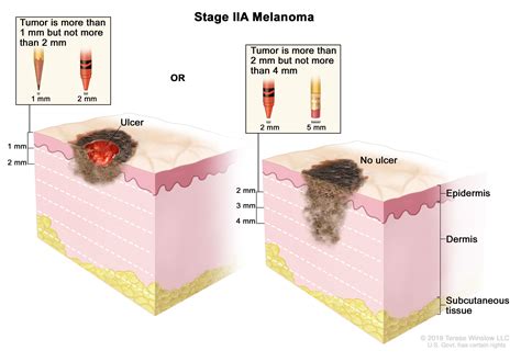 Melanoma Treatment (PDQ®)–Patient Version - National Cancer Institute