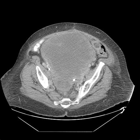 Leiomyosarcoma CT - wikidoc