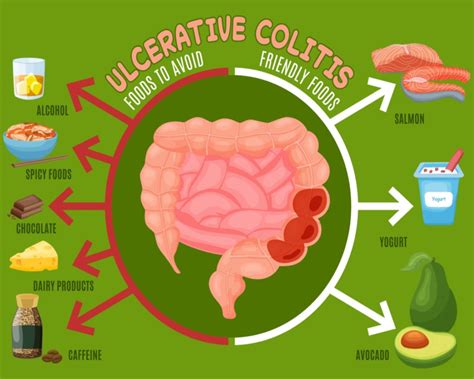 What is Ulcerative Colitis? | The IBS & Gut Health Clinic