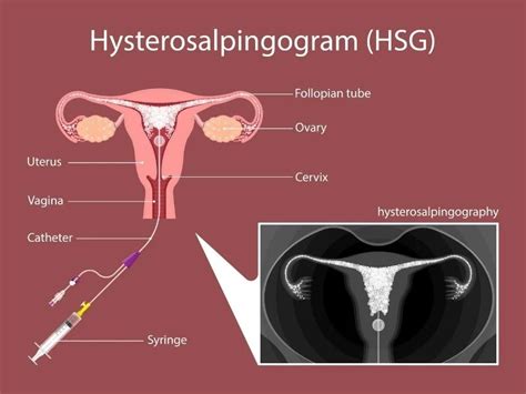 When is The Best Time to do HSG test? - Aastha IVF