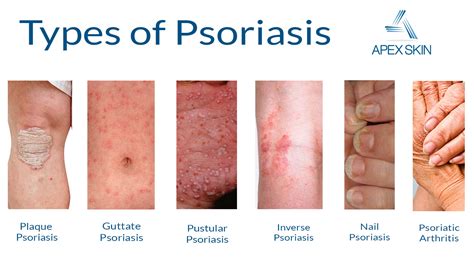 psoriasis , diagnosis and treatment