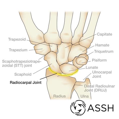 Wrist Pain — Dr Mark Hile Wrist and Hand Specialist Surgeon Sydney