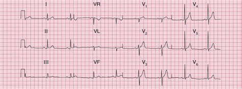 Normal Ecg Tracing