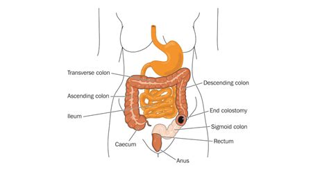 Colostomy - Possible complications of a colostomy