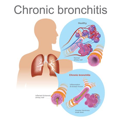 Bronchitis | Acute Bronchitis | Bronchitis Symptoms