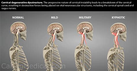 Vagus nerve compression in the neck: Symptoms and treatments