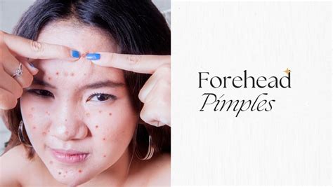 How To Get Rid Of Forehead Pimples - Types, Treatment