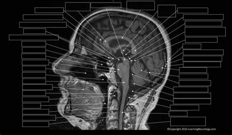 Approach to MRI brain | LearningNeurology.com