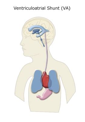 Fetal Hydrocephalus