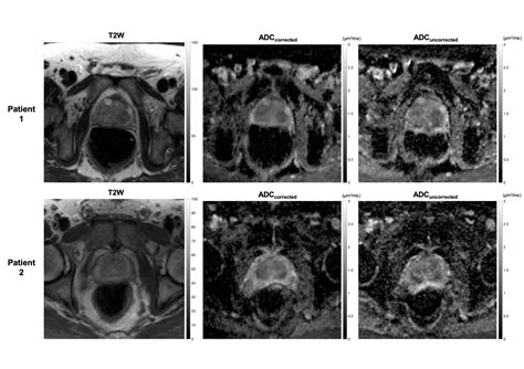 Distortion correction of a clinical standarddiffusion-weighted prostate ...