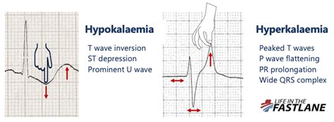 Hypokalemia Hyperkalemia Ecg