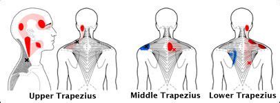 Upper Trapezius Trigger Point Pattern