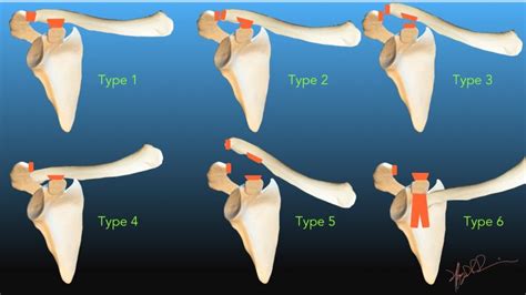 Rockwood Classification of Acromioclavicular Joint Separation | UW ...