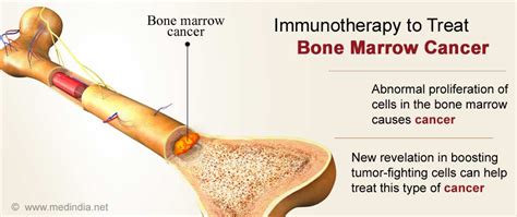 Bone Marrow Cancer - CancerWalls