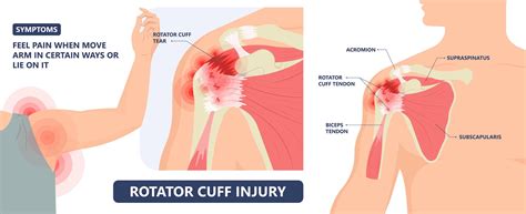 Do You Have A Rotator Cuff Tear? | Dr. Kyle McClintock