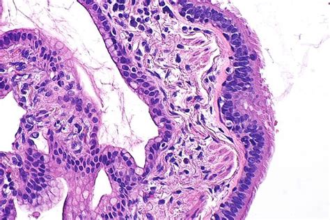 Mucinous carcinoma - Libre Pathology