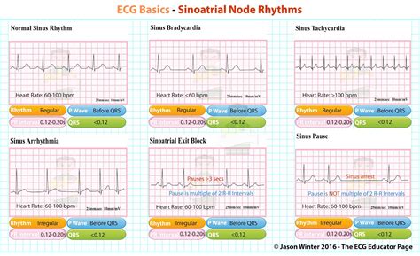 ECG Educator Blog : Sinoatrial Node rhythms