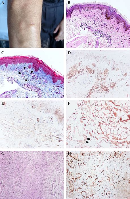 JLE - European Journal of Dermatology - Light chain deposition disease ...