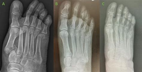 OSSIOfiber® ORIF of 1st TMT Fracture/Dislocation & 2-5 Metatarsal Fractures