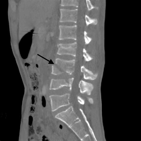 Cureus | Delayed Small Bowel Incarceration Within a Lumbar Burst ...