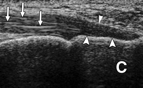 Sonography of Common Tendon Injuries | AJR