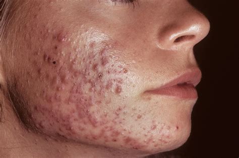 Hormonal Antiandrogen Therapy for Acne May Help Reduce Antibiotic Use ...