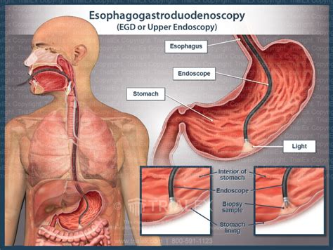 Esophagogastroduodenoscopy (EGD or Upper Endoscopy) - TrialExhibits Inc.