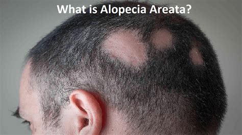 What is Alopecia Areata, its Causes, Symptoms, Treatment, Diagnosis ...