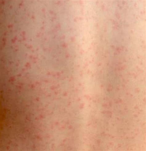 Scarlet fever: Causes, symptoms, treatment, and complications