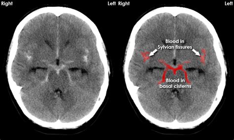 Intracerebral Hemorrhage Vs Subarachnoid Hemorrhage