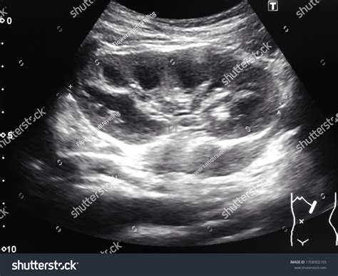 Normal Kidney Ultrasound