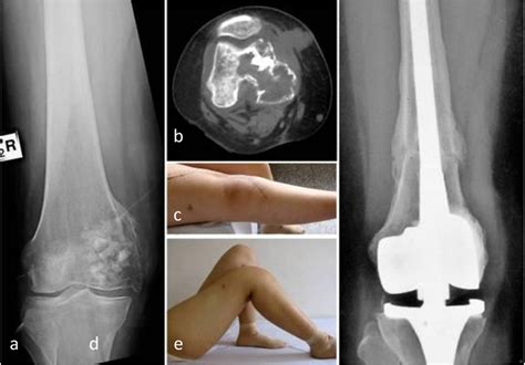 A patient with postoperative recurrence of bone giant cell tumor in ...