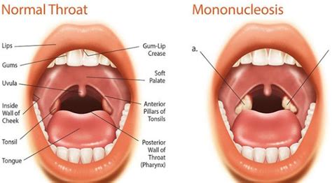 Symptoms Of Mono In Children | CBC Parents