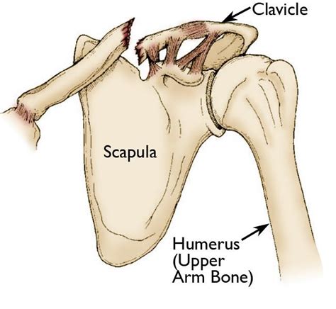 Clavicle Fracture (Broken Collarbone) - OrthoInfo - AAOS