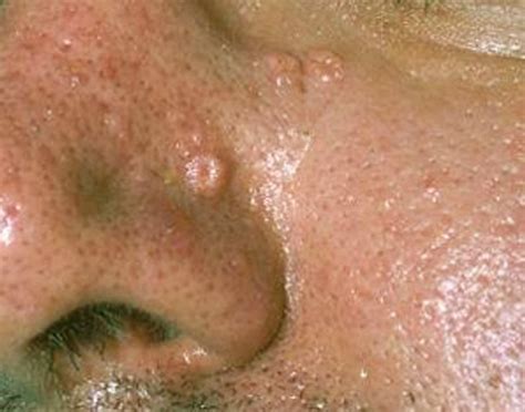 Sebaceous Hyperplasia - Pictures, Removal, Symptoms, Treatment, Causes